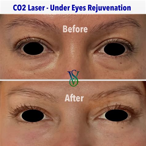 co2 laser resurfacing under eyes